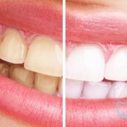 Blanqueamiento Dental Blog