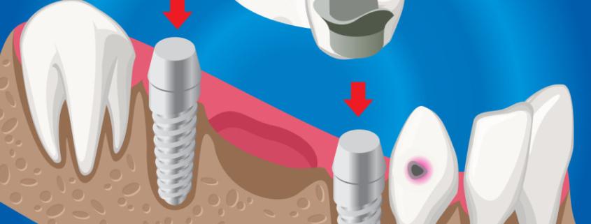 Sistema CAD/CAM: Coronas en una sesión